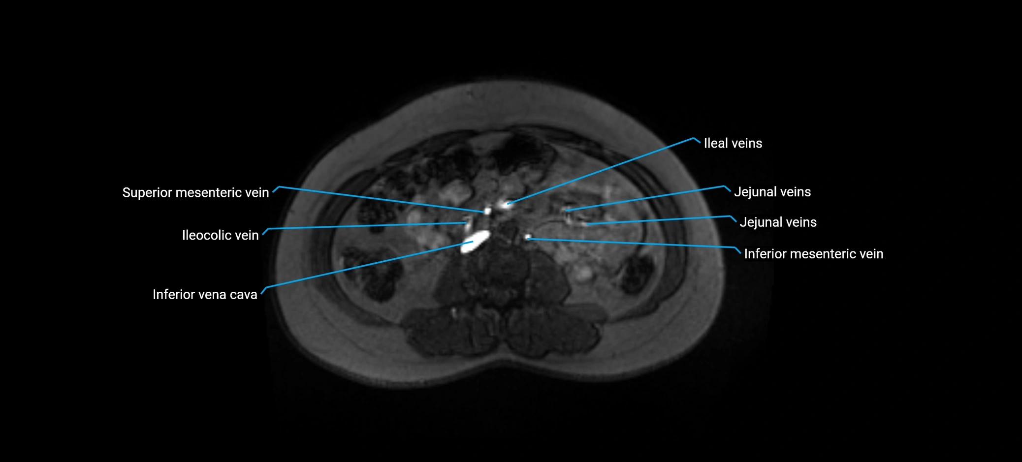 MRV abdomen pelvis & lower limb axial cross sectional anatomy labelled MRI image 93 (1).webp